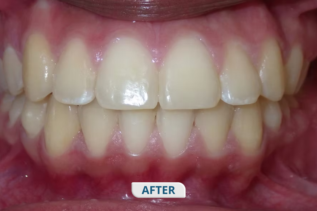 After treatment at Namira Oro Dental Care